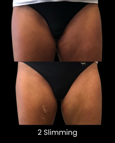 Cryoskin Slimming Before and After