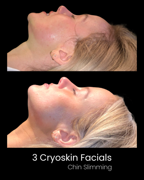 Cryoskin Facial Before and After - Double Chin Slimming