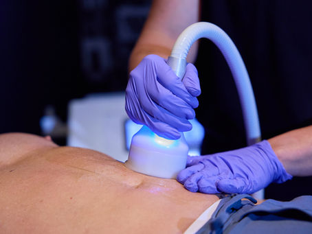 Cryoskin Toning: Muscle Activation & Skin Firmness Without Overtraining