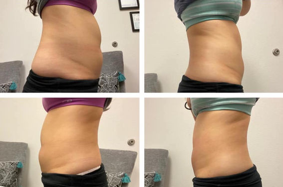Cryoskin Before and After 2 Slimming Treatments