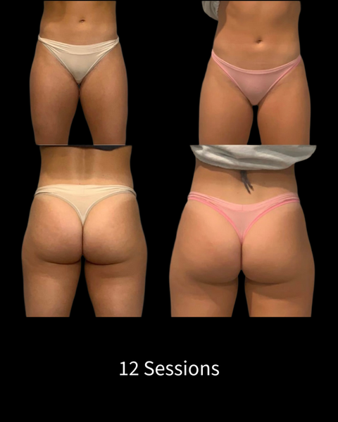 Endosphères Therapy Before and After