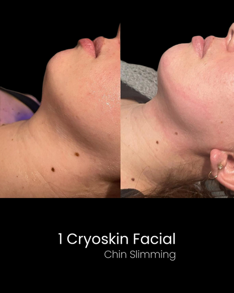 Cryoskin Facial Before and After - Double Chin Slimming