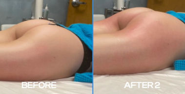 Lymphatic Drainage Endosphères Therapy Before and After Results
