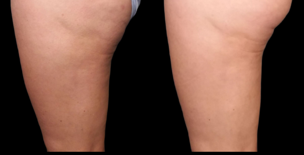 Cryoskin Toning Helps Tighten Skin Through Circulation and Collagen Support