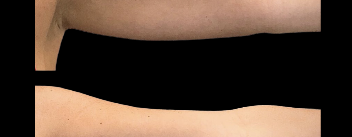 Before and After Cryoskin Slimming