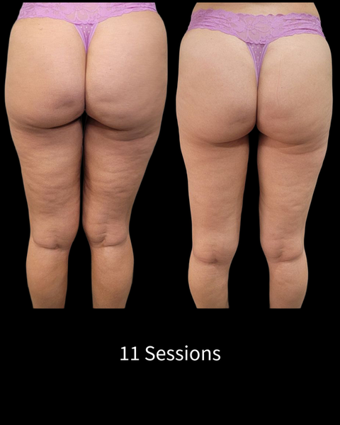 Endosphères Therapy Before and After