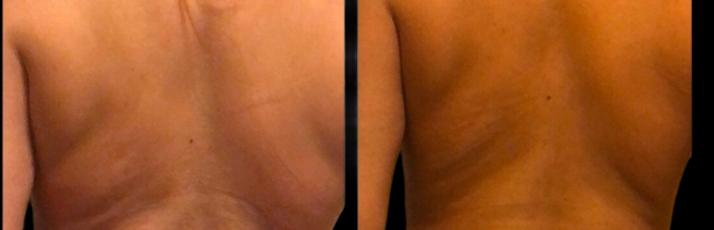 Before and After Cryoskin Slimming - CryoSlimming