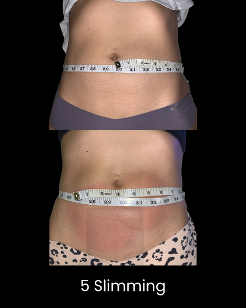 Cryoskin Slimming Before and After