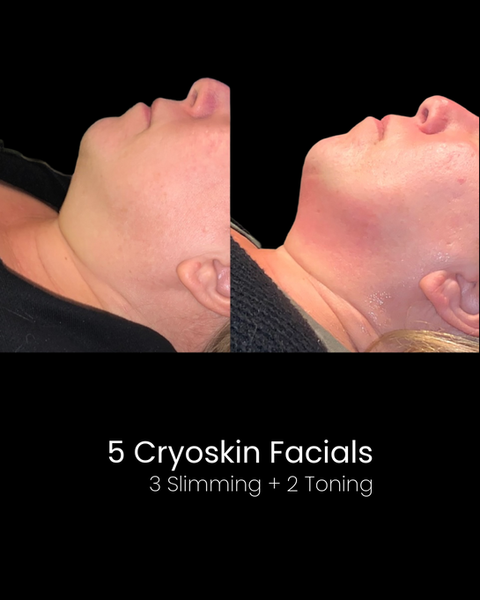 Cryoskin Facial Before and After - Double Chin Slimming