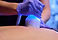 Cryoskin Toning CryoToning