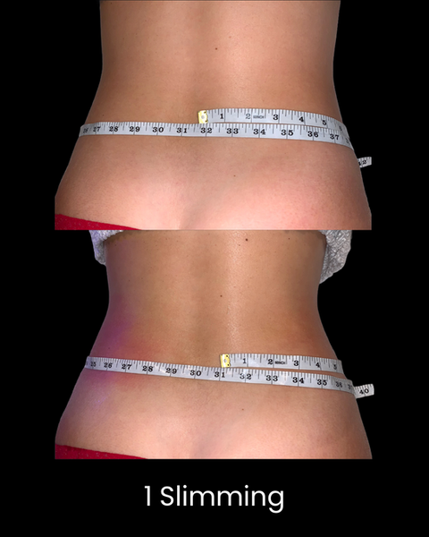 Cryoskin Slimming Before and After