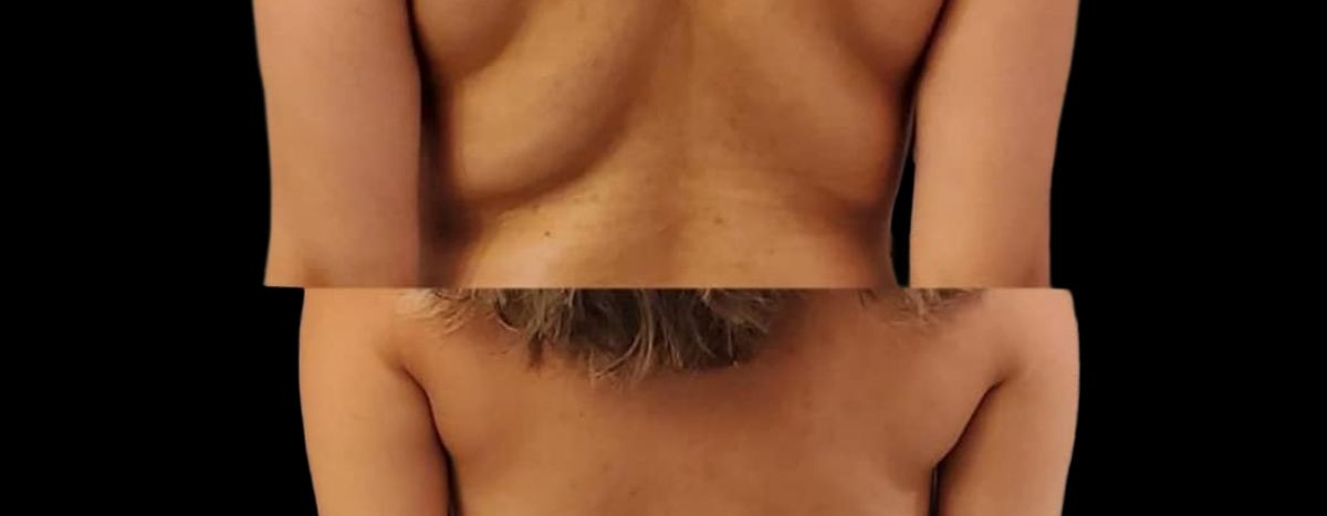 Before and After Cryoskin Slimming