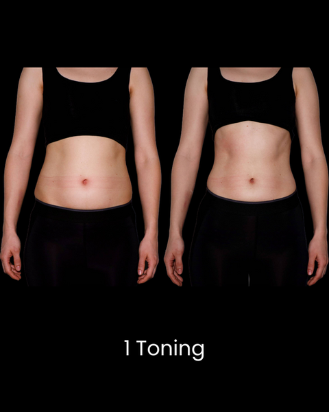 Before and After Cryoskin Toning