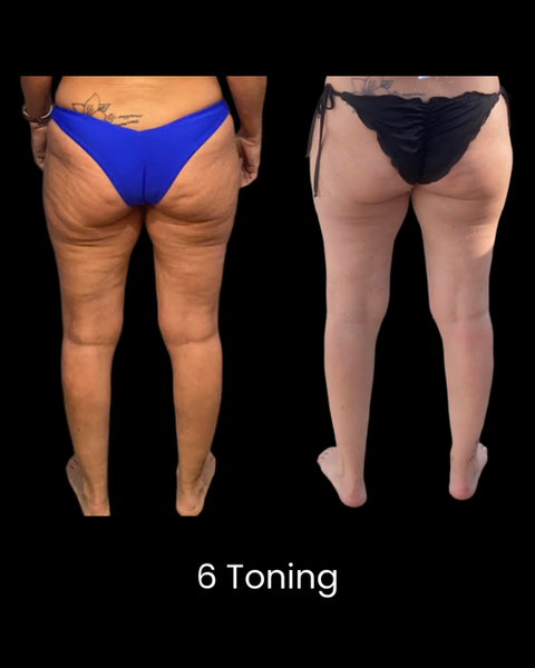 Before and After Cryoskin Toning