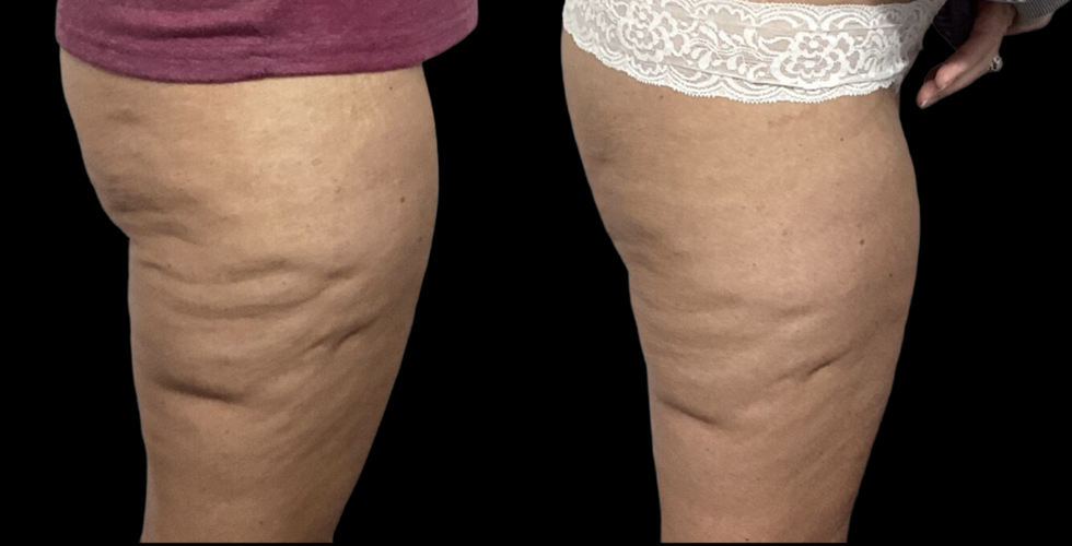 Cryoskin Toning Helps Tighten Skin Through Circulation and Collagen Support