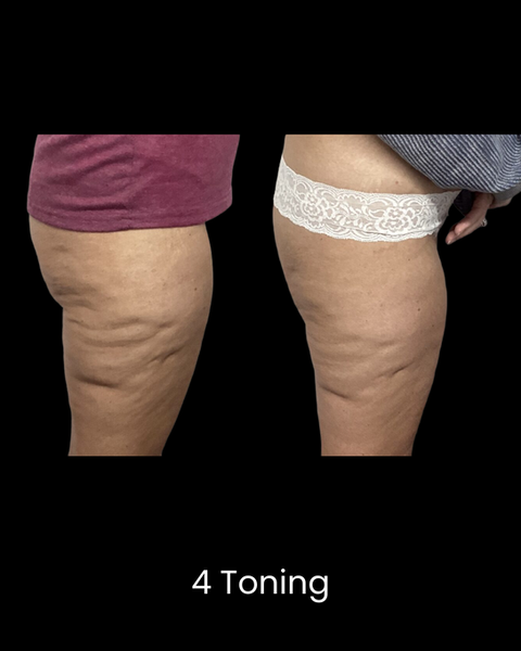 Before and After Cryoskin Toning
