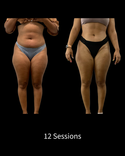 Endosphères Therapy Before and After
