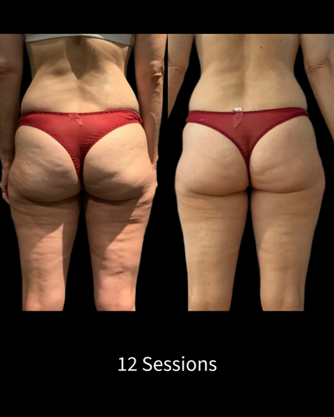 Endosphères Therapy Before and After