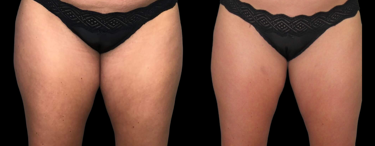 Before and After Cryoskin Slimming and Toning - Abdomen CryoSlimming