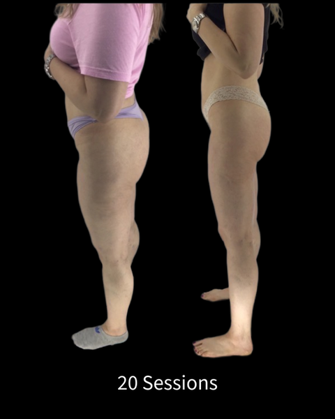 Endosphères Therapy Before and After