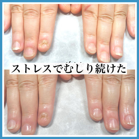 深爪とストレスの関係