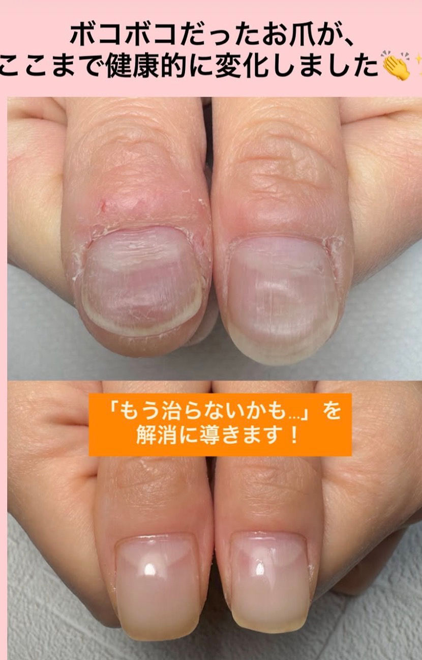 お客様の爪変化