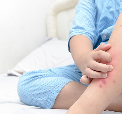 use-to-soothe-itchy-bug-bites-1708993704.jpg