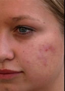 glycolic acid before 2.jpg
