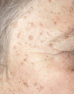 age-spot-removal3.gif