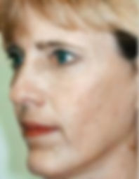 glycolic acid chemical peel before 3.jpg