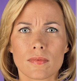 Botox Before1.jpg