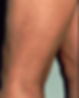 Spider Veins on legs after laser removal.jpg
