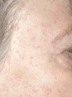 age-spot-removal5.gif