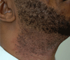 before and after laser hair removal black skin1.gif