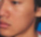 microneedling-acne scars-after