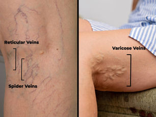 An image showcasing the visual difference between reticular veins, spider veins, and varicose veins.