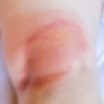 A photo of a person's leg, with apparent eczema.