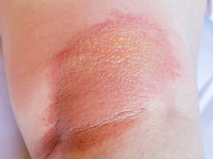 Could Your Itchy Eczema be a Sign of Venous Problems?