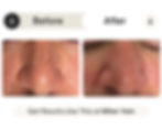 An impressive before-and-after photo featuring the transformation after VeinGogh spider vein treatment at Miller Vein