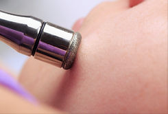 Microdermabrasion