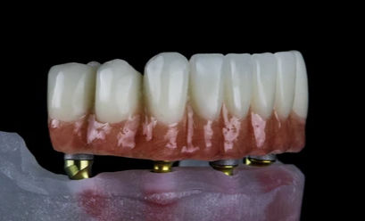 Prothèse dentaire fixe sur implants