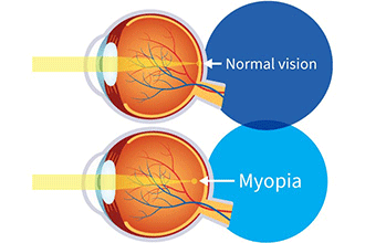 Myopia Refractive Error Explained