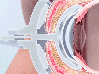 Lipiflow.gif