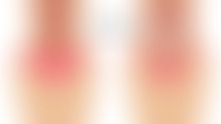 Magmuskeldelning/Diastasis Recti - Kan man göra något åt saken?