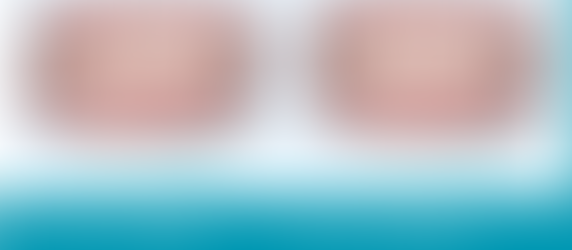 案例分享-錯咬、門牙突