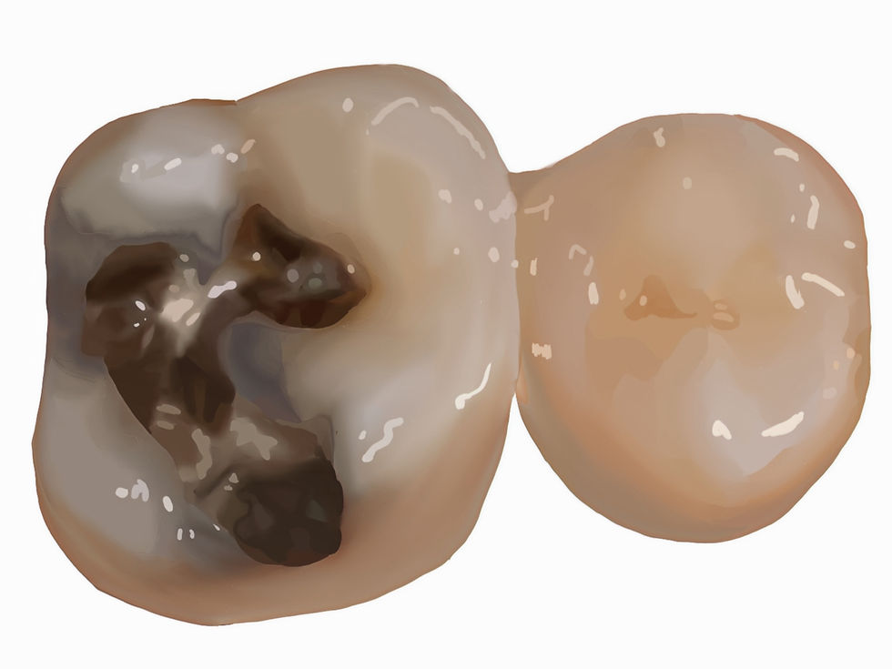 Ariel view of a molar with a occlusal silver filling highlighting a bluish grey stain from the amalgam