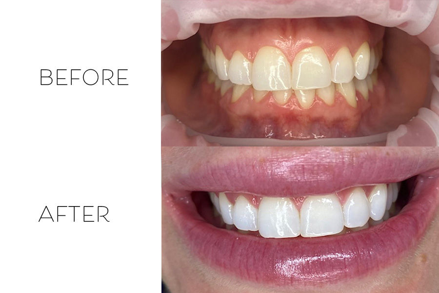 Before & After Teeth Whitening