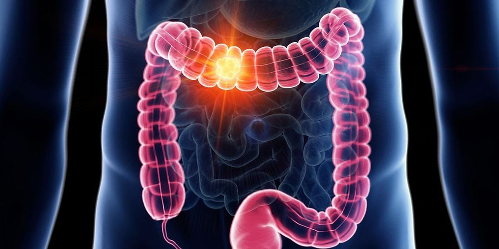 Colorectal cancer is on the rise