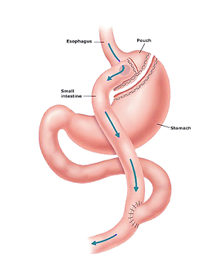 Gastric-Bypass-Image-2014.png