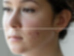 Nodulocystic Acne can be managed with oral antibiotics or Accutane (isotretinoin)